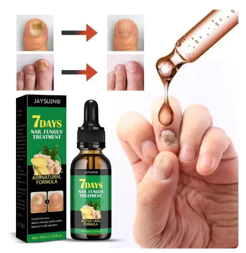 Tratamento Natural Contra Fungos – 7 Dias de Resultados Comprovados! ¡Compra 1 y obtenga 2 HOY!