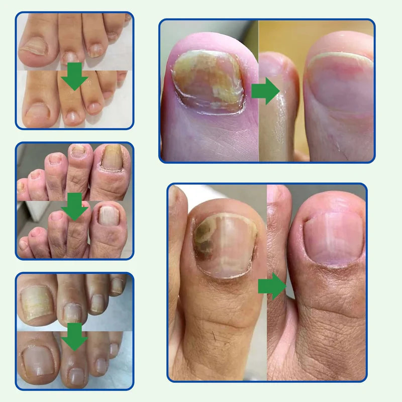 Tratamento Natural Contra Fungos – 7 Dias de Resultados Comprovados! ¡Compra 1 y obtenga 2 HOY!